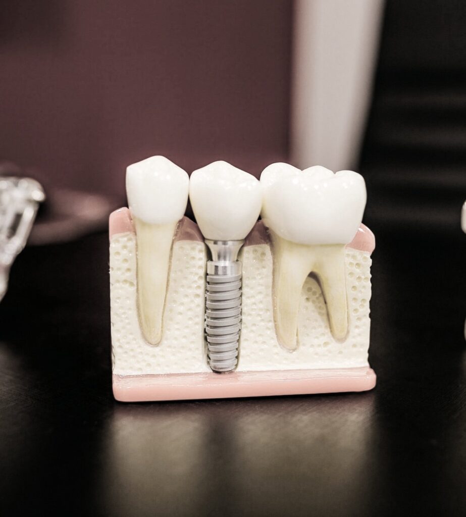Dental Implants