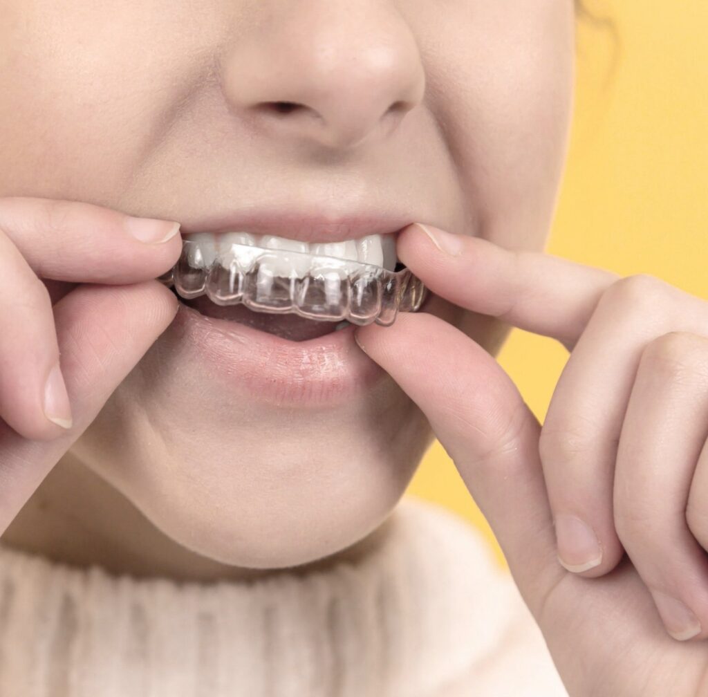 patient wearing invisalign aligner
