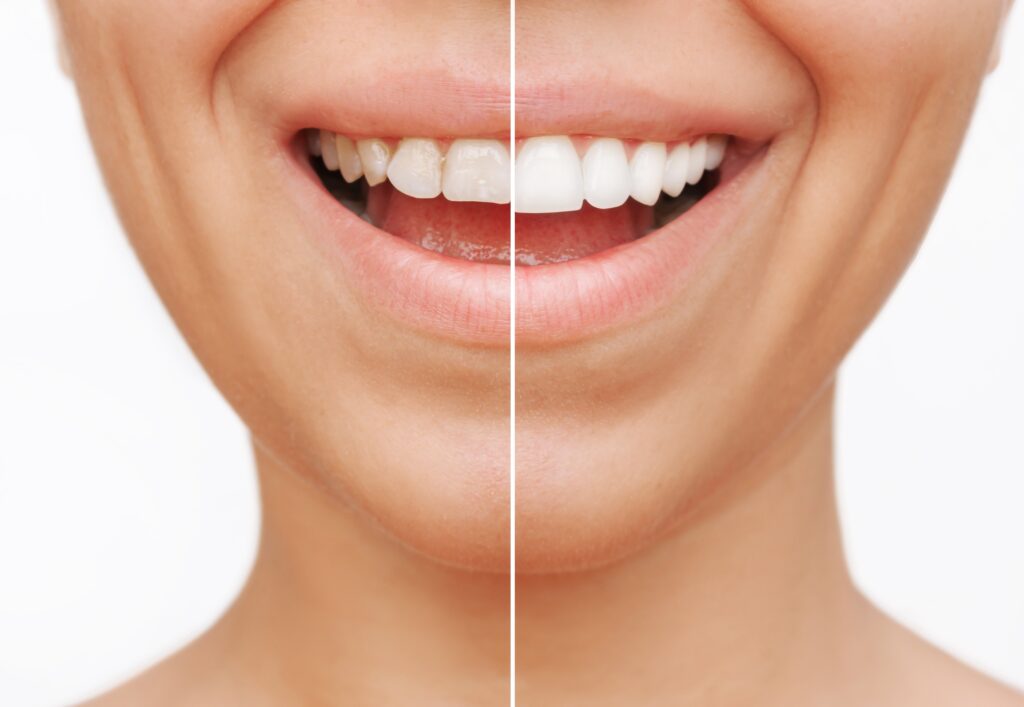 Side by side before and after comparison of the mouth a woman after receiving restorative dental treatment