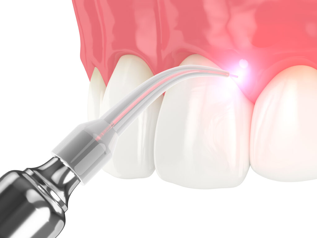3D rendering of a dental diode laser reshaping the gums in a mouth