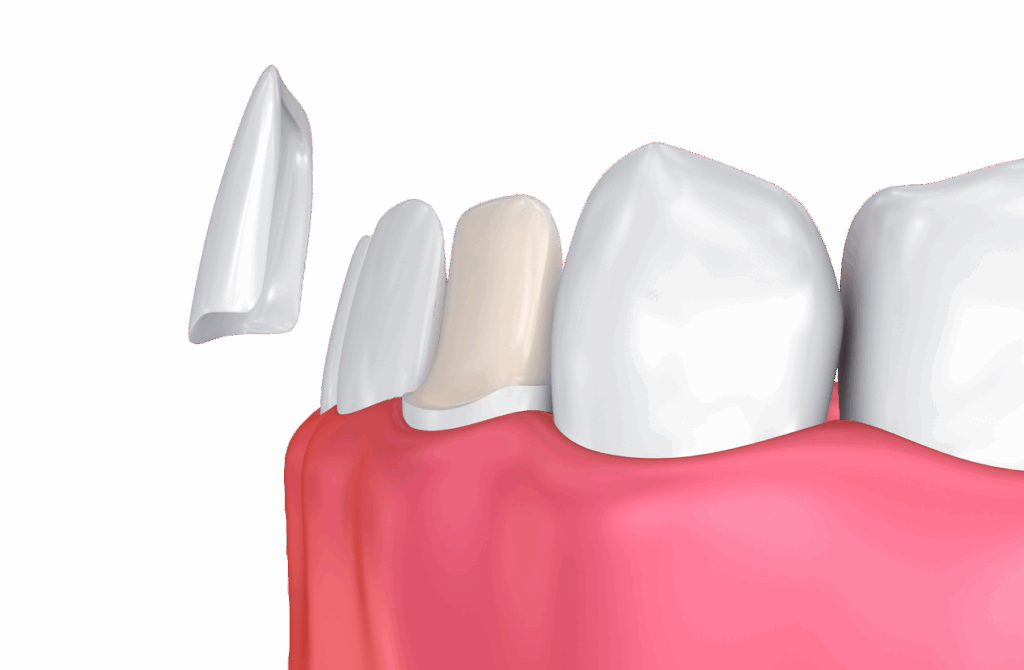 3-D diagram of a veneer being put applied to a damaged tooth