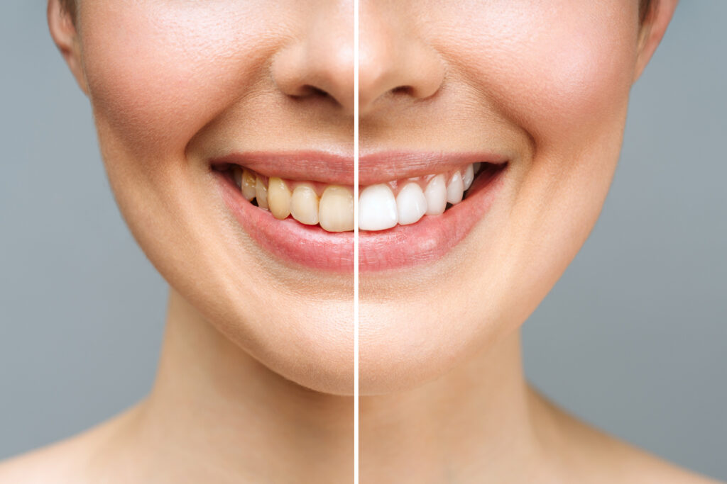 Woman Teeth Before And After Whitening. Over White Background. Dental Clinic Patient. Image Symbolizes Oral Care Dentistry, Stomatology