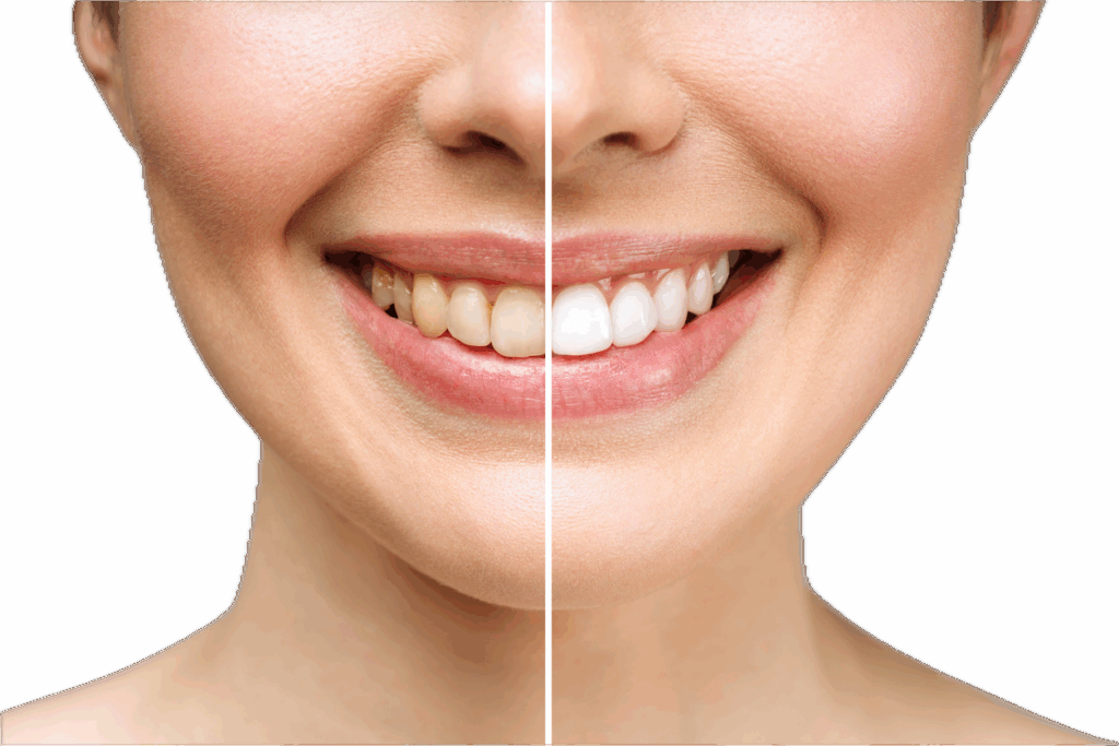 Before and after comparison of a woman’s smile undergoing teeth whitening