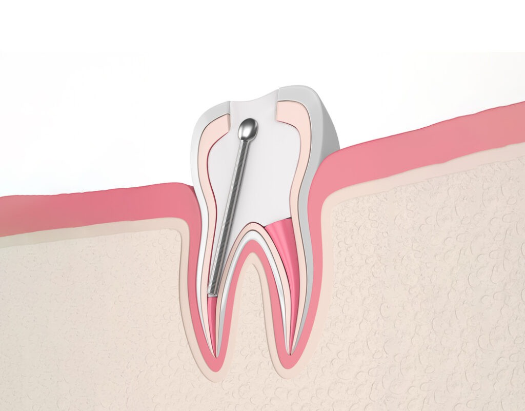3-D diagram of a singular teeth receiving root canal therapy