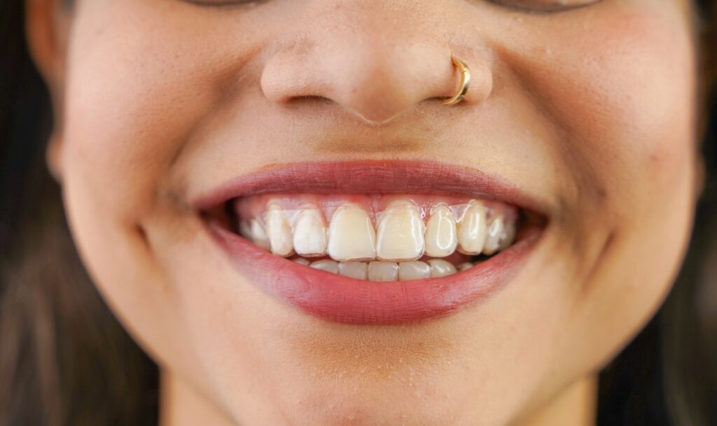 Close up of the smile of a young woman with Invisalign® and a gold nose ring