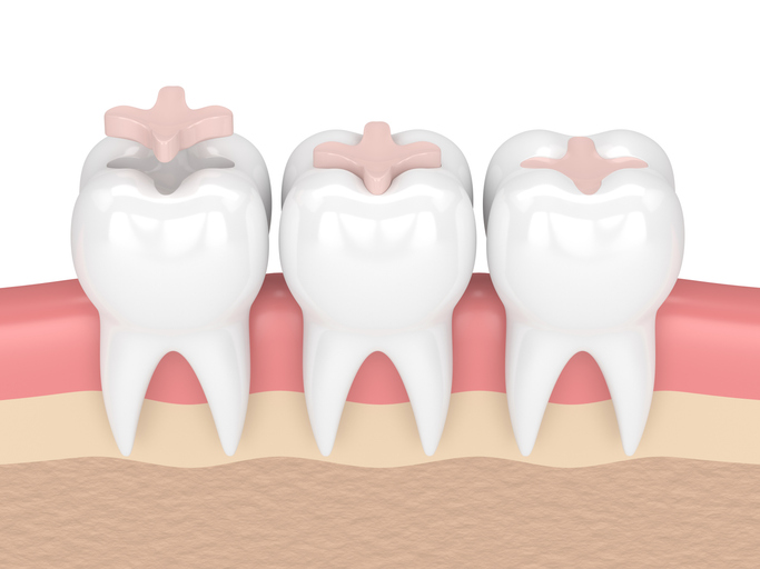 3-D diagram of dental fillings being placed on 3 teeth