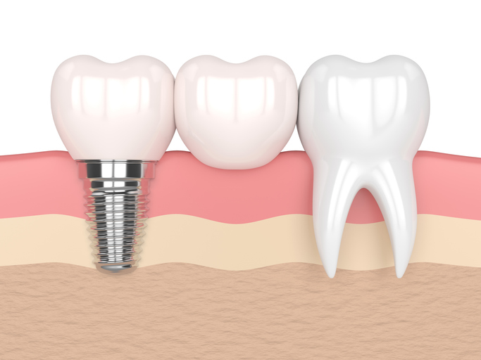 3-D diagram of a dental implant anchored into the bottom jawline