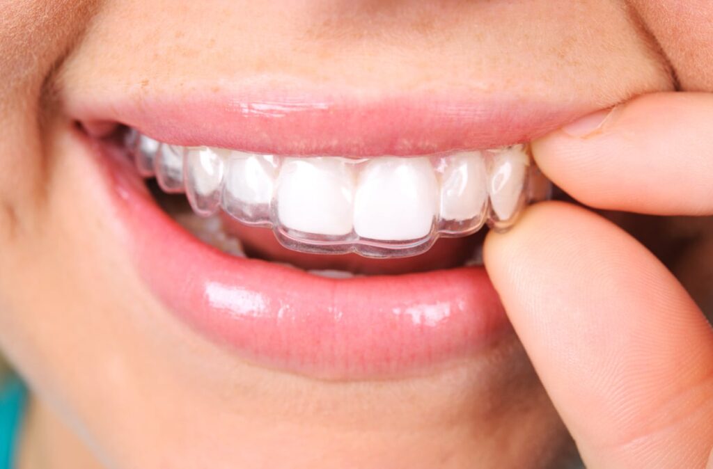 Close up of a young woman inserting her top Invisalign aligner.