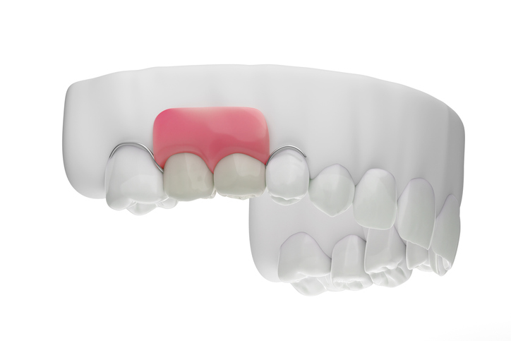 A partial denture on the top right row of teeth in color while the rest of the mouth is not