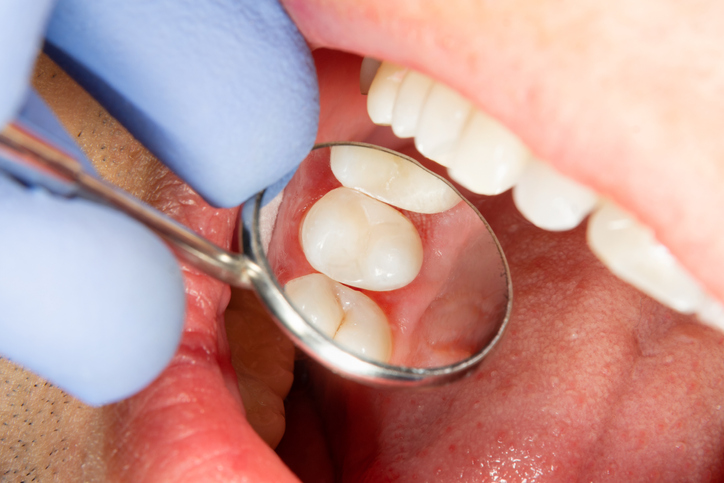 Extreme close-up of the sealant of a patient being examined by his dentist with a dental mirror