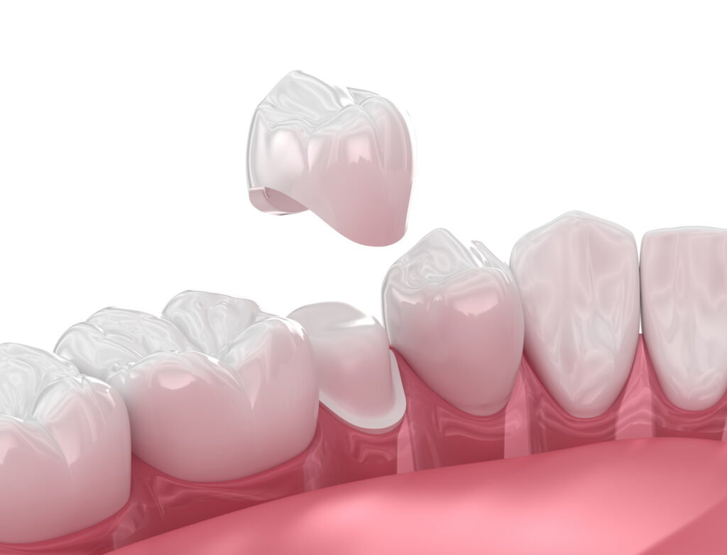 Dental Crown Placement Over Tooth. 3d Illustration